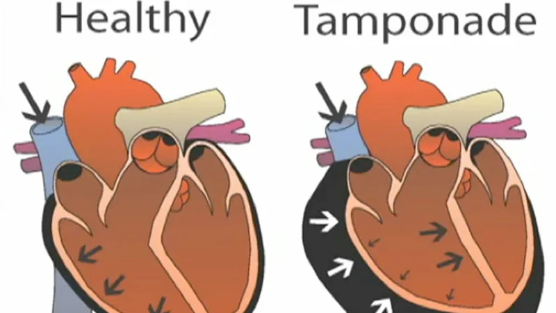 tamponade-la-gi