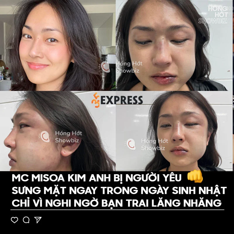 misoa-to-bi-ban-trai-long-dinh-bao-hanh-1-35express