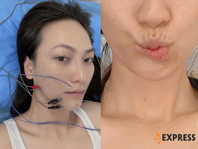 phuong-anh-dao-bi-lech-meo-khuon-moi-sau-khi-mo-tuyen-giap-35express