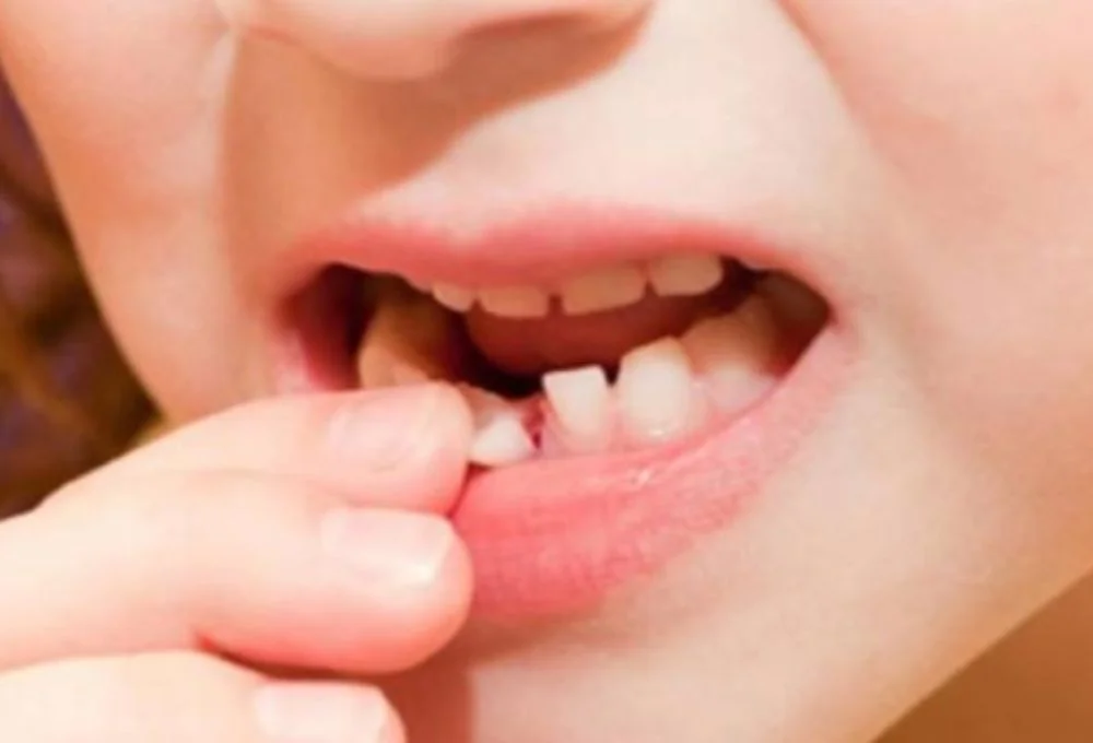 Ngủ mơ thấy rụng răng hàm dưới