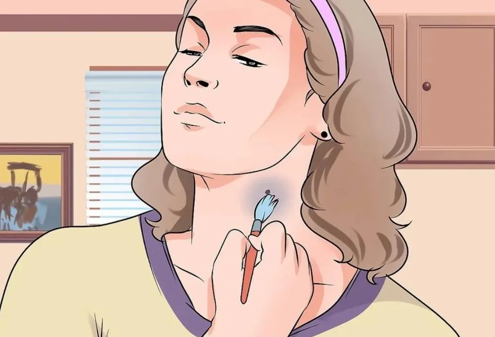Cách làm mờ vết hickey nhanh chóng